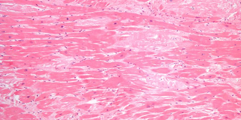 Tafamidis attenuates the decline of cardiac function in patients with transthyretin amyloid cardiomyopathy