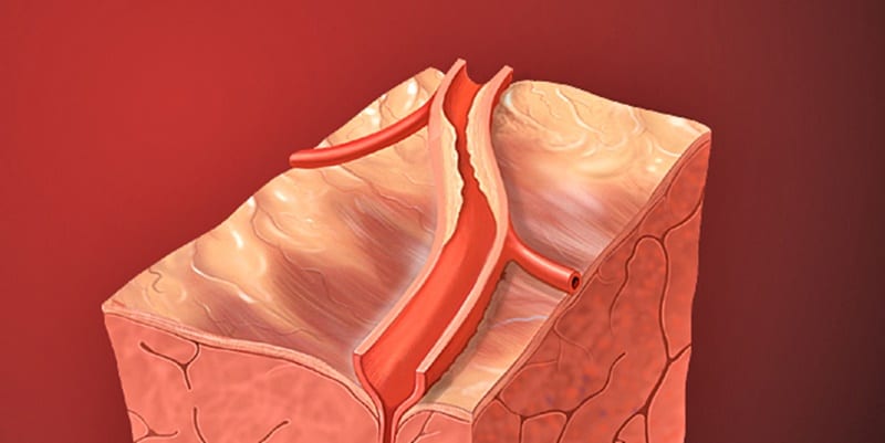 Percutaneous coronary intervention associated with decreased stable angina symptoms