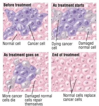 Systemic Therapy and Stereotactic Body Radiotherapy in Oligoprogressive Breast Cancer or Lung Cancer