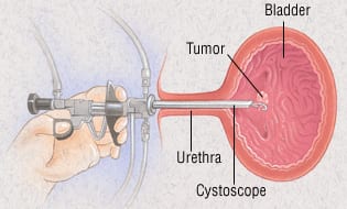 Comparison of two chemotherapy regimens in muscle invasive bladder cancer