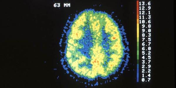 AI Prediction Models Fail Across Clinical Trials