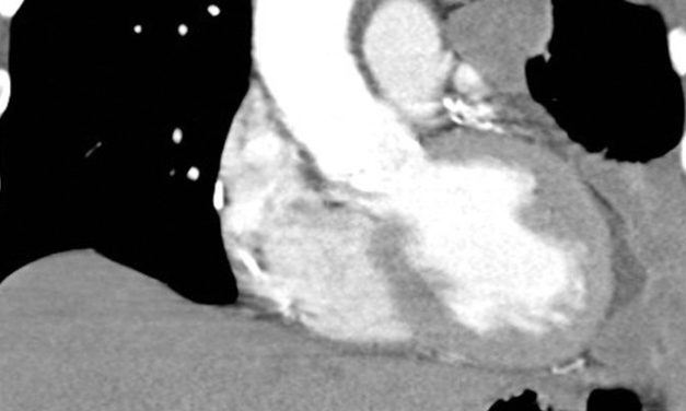 Pembrolizumab and chemotherapy combination improves survival in advanced pleural mesothelioma