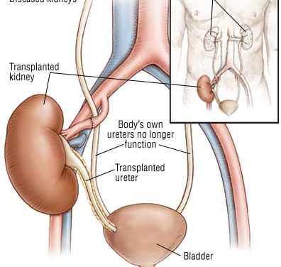 Cemiplimab for Kidney Transplant Recipients With Cutaneous Squamous Cell Carcinoma