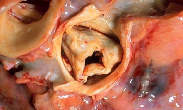 Non-invasive ultrasound therapy safely improves aortic valve function in high-risk patients with calcified aortic stenosis