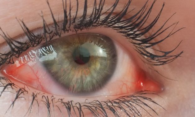 Inflammatory Markers in Tear Fluids Predict Dupilumab-Associated Ocular Surface Disease