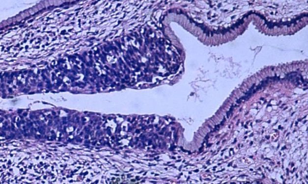 Atezolizumab in addition to bevacizumab and platinum-based chemotherapy improves survival in metastatic cervical cancer