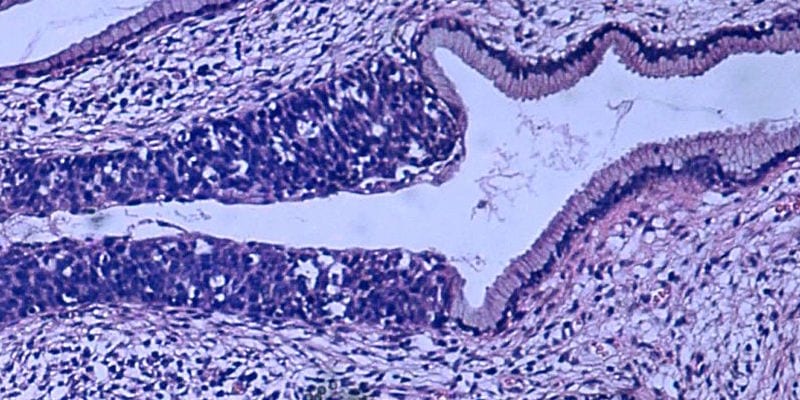 Atezolizumab in addition to bevacizumab and platinum-based chemotherapy improves survival in metastatic cervical cancer