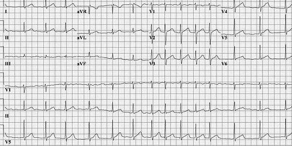 Apixaban lowers the risk of stroke in subclinical atrial fibrillation