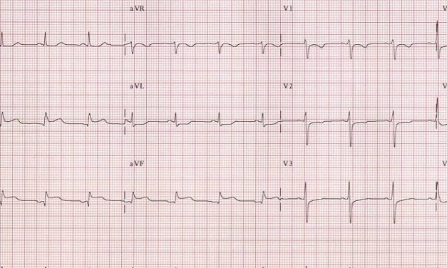 ST-elevation myocardial infarction with nonobstructive coronary arteries associated with significant mortality