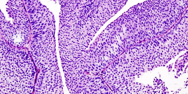 Updated Outcomes of Sacituzumab Govitecan in Resistant Advanced Urothelial Carcinoma