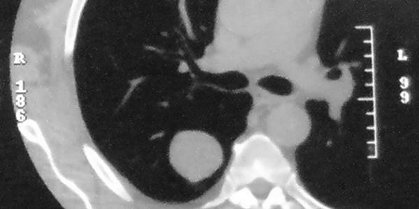 Stereotactic body radiotherapy enhances survival in patients with non-small cell lung cancer