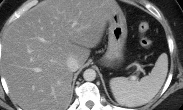 Resmetirom improves liver fibrosis in nonalcoholic steatohepatitis