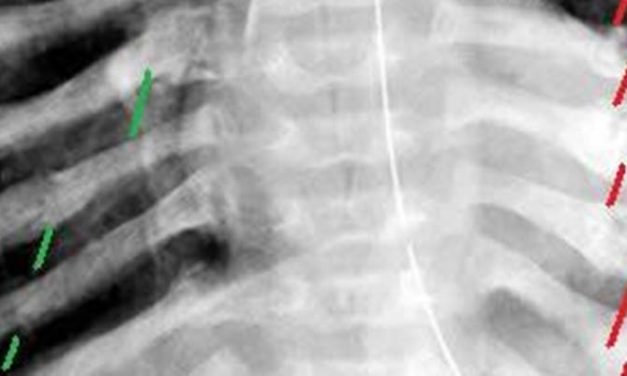 Higher quantity of rib fractures may be a risk factor for venous thromboembolism