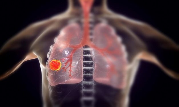 Transition to Neoadjuvant Therapy for Resectable NSCLC Safe & Feasible