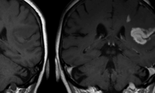 Short-term and long-term risk of recurrent ischemic strokes in young adults by cause