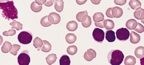 Venetoclax monotherapy effectively treats relapsed or refractory chronic lymphocytic leukemia