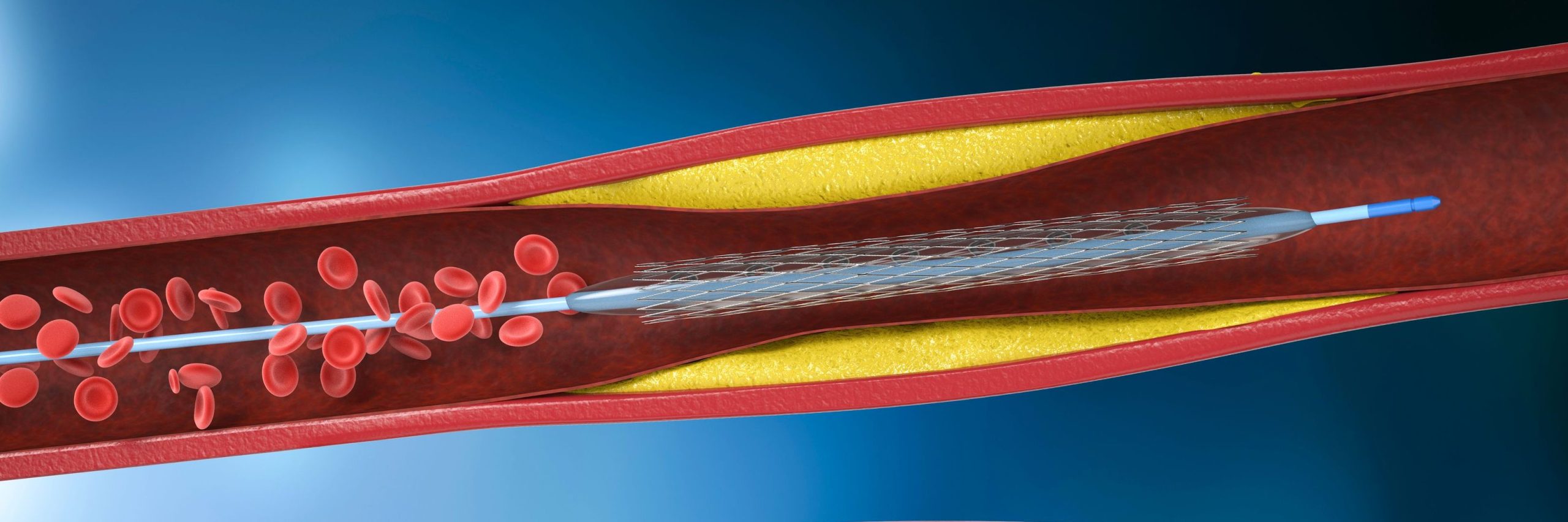 FFR-Guided Complete Percutaneous Coronary Intervention Is Non-Superior to Culprit-Only Percutaneous Coronary Intervention