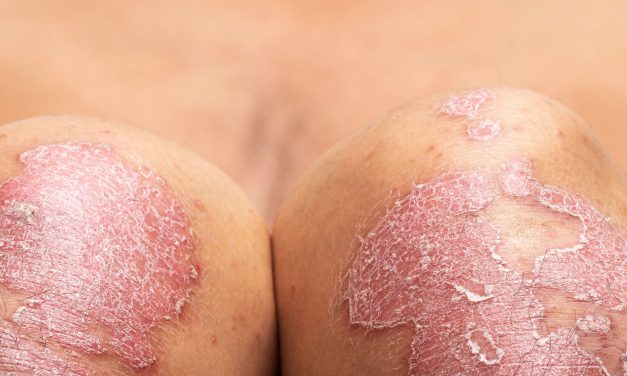 Biologics Effective for Very Severe Plaque Psoriasis