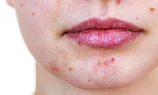 Study Identifies Factors That Affect Antibiotic Prescribing for Acne