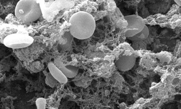 Novel prophylactic anticoagulation scoring tool helps stratify patients following lower limb trauma