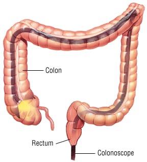 Neoadjuvant chemotherapy does not appear to significantly improve disease-free survival in patients with locally advanced colon cancer