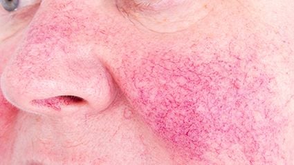 Erenumab Effective, Safe for Rosacea-Linked Erythema, Flushing