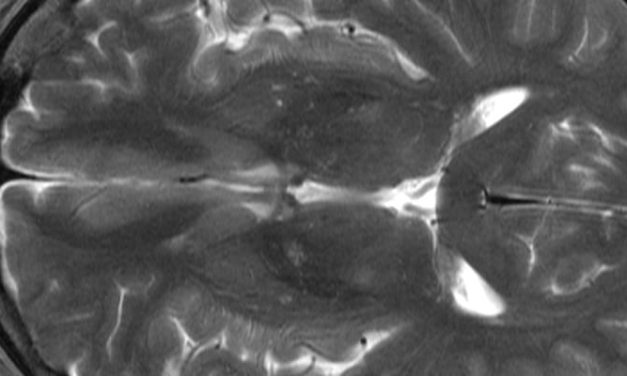 Minimally invasive surgery provides functional benefit in acute supratentorial intracerebral hemorrhage