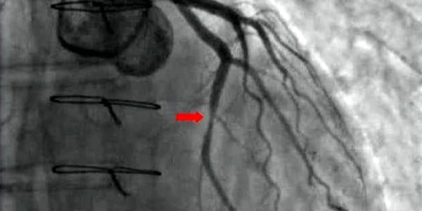 Beta-blockers do not lower mortality after myocardial infarction with preserved ejection fraction