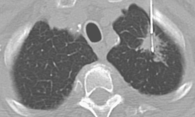 Gefitinib with Chemotherapy in EGFR-Mutated Lung Cancer