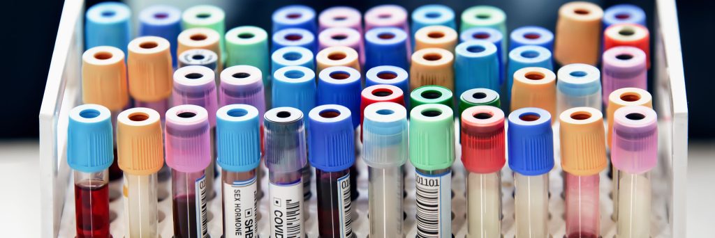 blood serum, serology, blood tubes in tray in workbench of the laboratory. rack with tubes blood samples from patients for analysis in the hematology lab