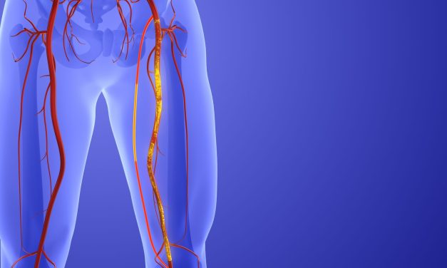 Peripheral Artery Disease: Procedure-Guidance by IVUS Superior to Angiography