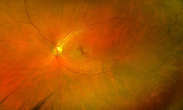 VEGF Inhibitors in Naïve Branch Retinal Vein Occlusion Show Promising 3-Year Outcomes