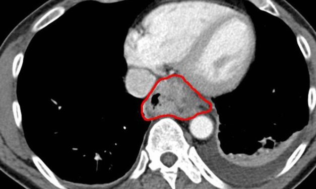 Capecitabine or XELOX did not appear to improve overall survival when compared to PF in patients with advanced Esophageal Squamous Cell Carcinoma