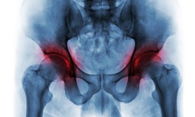 Worse Outcomes Seen for Severe Bilateral Hip OA in Adult Spinal Deformity